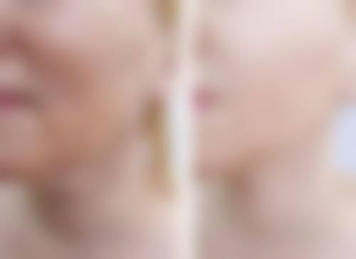 六、烫伤疤痕淡化的注意事项