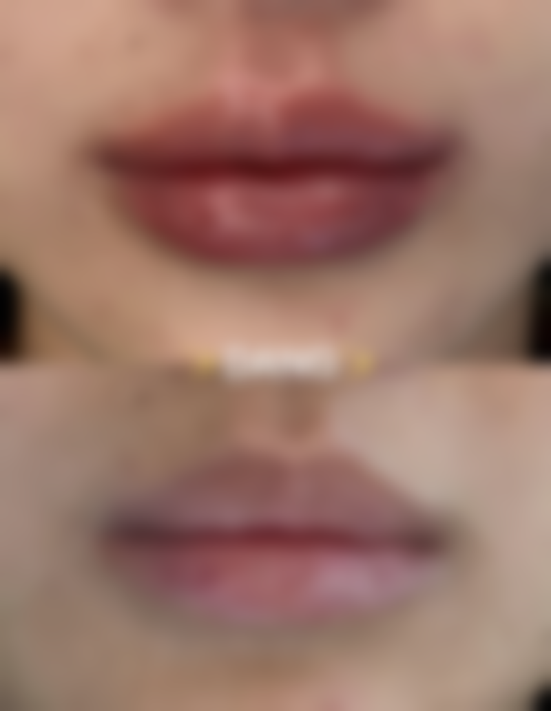 三、凹陷疤痕为什么是红色的——表皮变薄透色