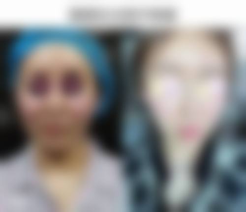 一、做了双眼皮眼睛会变大吗?手术成效揭秘