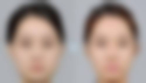 一、了解手术留下的疤痕疙瘩