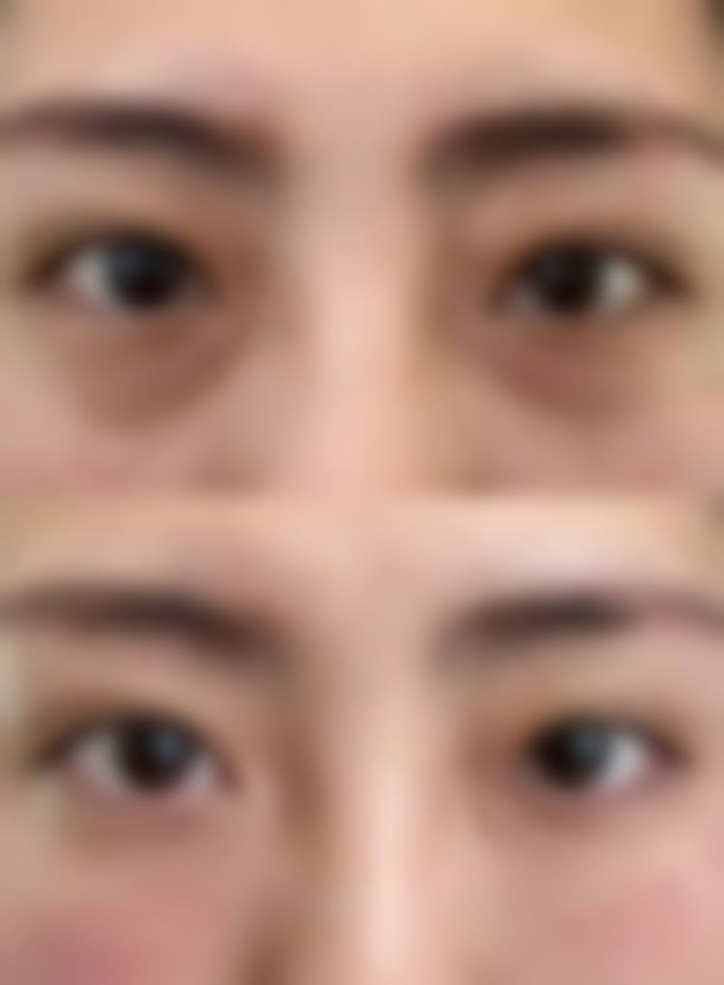 二、割双眼皮后分阶段护理注意事项