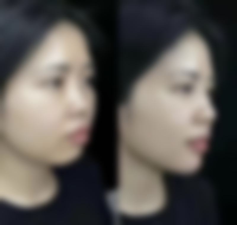 隆胸假体如何选择科学？从材质、形状到切口，掌握这些方法选对假体 