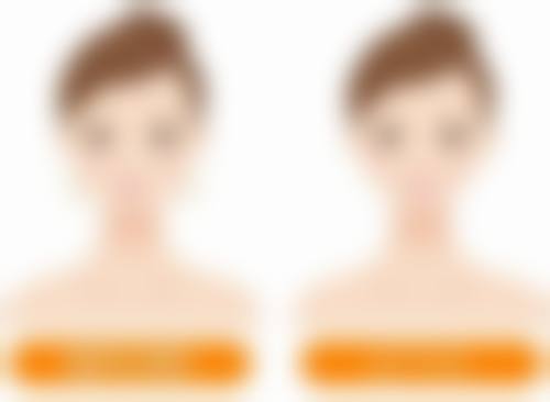 九、全切双眼皮去皮手术的成效评估