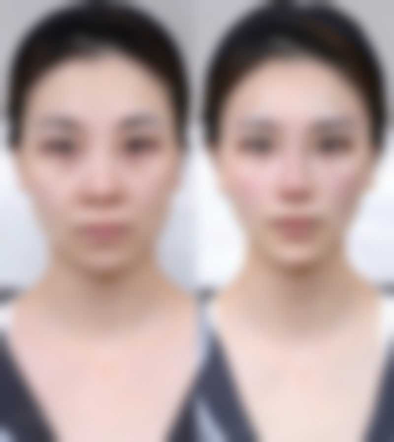 三、全切双眼皮去皮量的测算