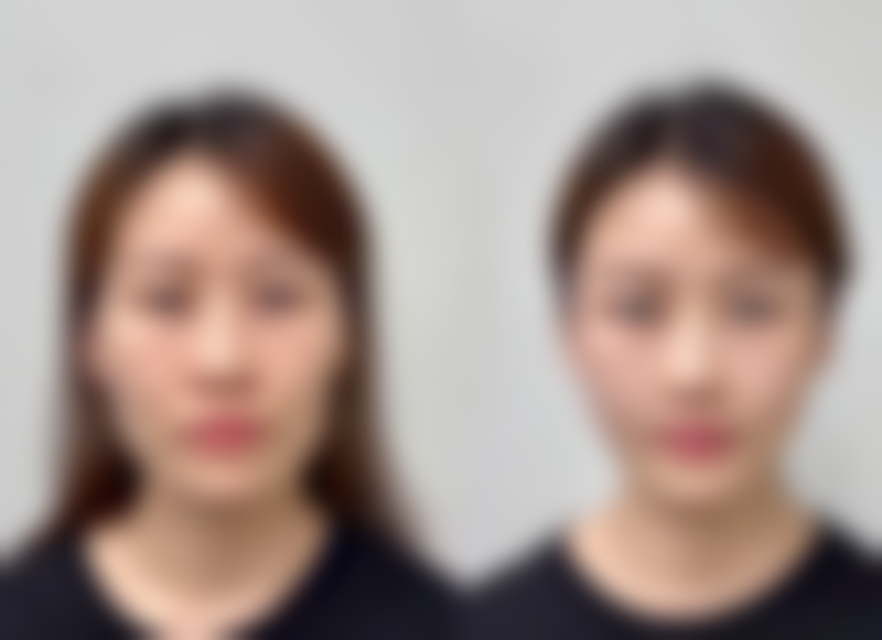 二、全切双眼皮去皮的目的