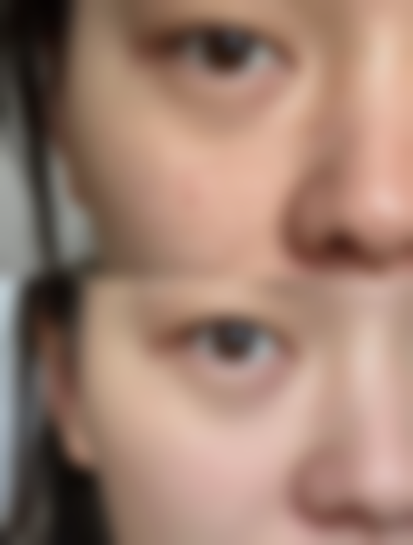 四、全切双眼皮去皮的范围