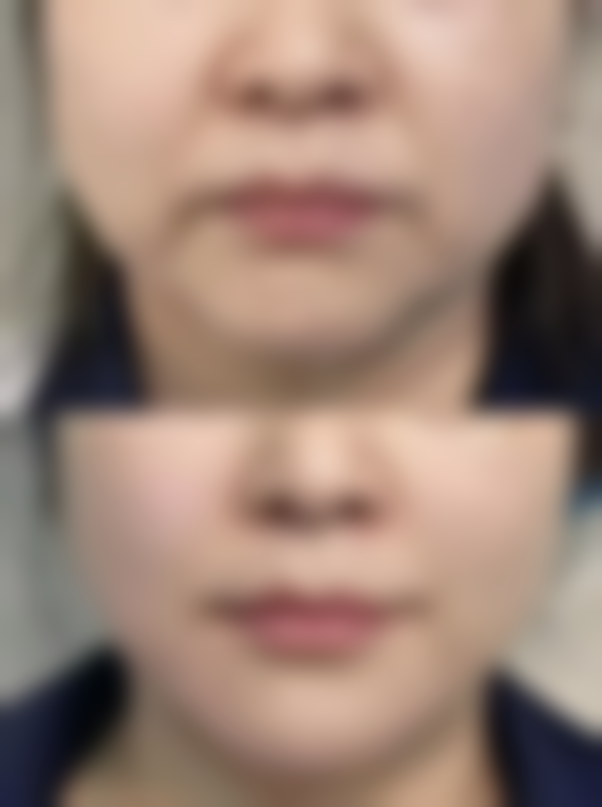 怎么才能去掉多年的眼袋和皱纹？这些医美手段与日常护理方法值得尝试！ 