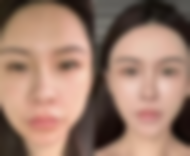 怎么才能去掉多年的眼袋和皱纹?这些医美手段与日常护理方法值得尝试!