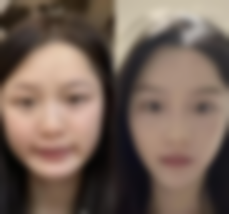 八、全切双眼皮去皮手术后的护理