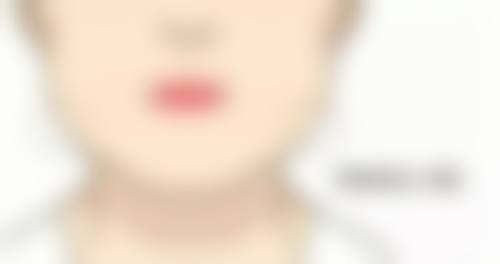 二、双眼皮第十二天怎么还是肿：肿胀程度自测参考