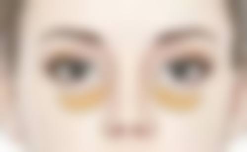 五、自体脂肪隆胸需要注意的风险