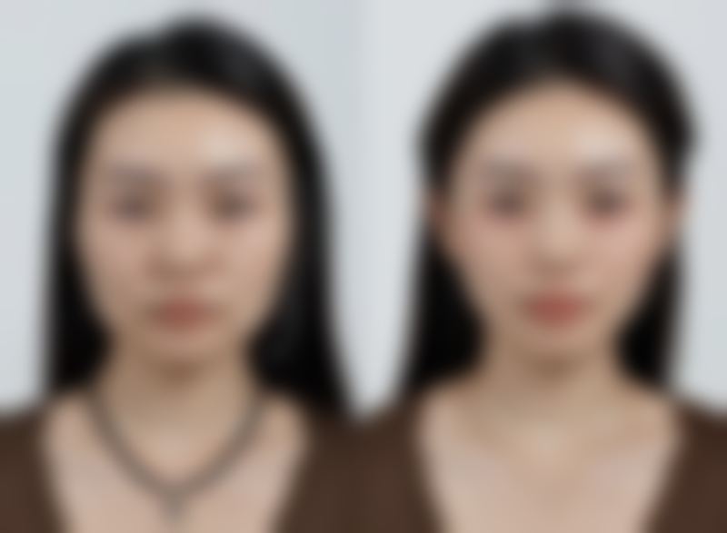 四、做双眼皮大概多长时间之不同术式修复至自然状态的时长