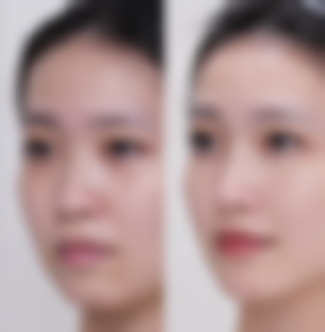 二、影响自体脂肪隆胸维持时间的主要因素