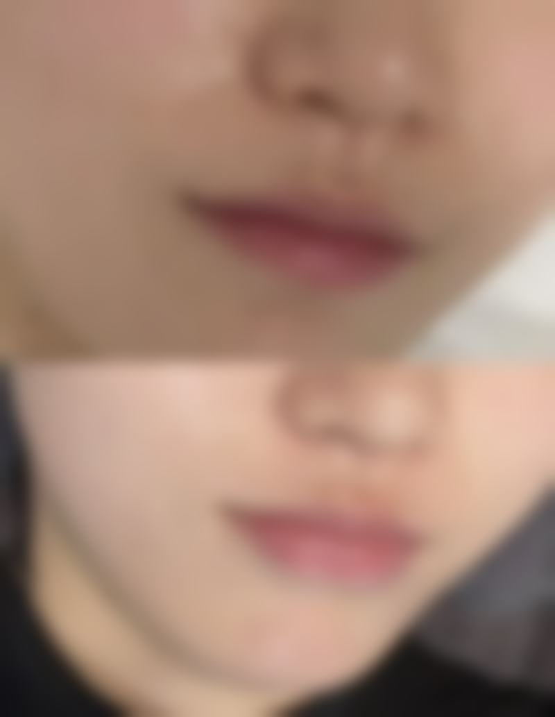 四、割完双眼皮后多久能喝酒