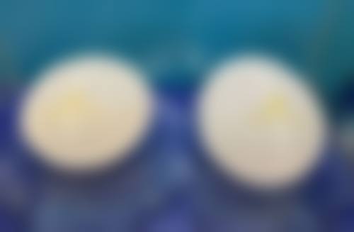 割双眼皮自然要多久恢复？受手术方式、体质等影响，1 - 6 个月差异大！ 