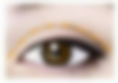 二、不同阶段的割双眼皮修复情况