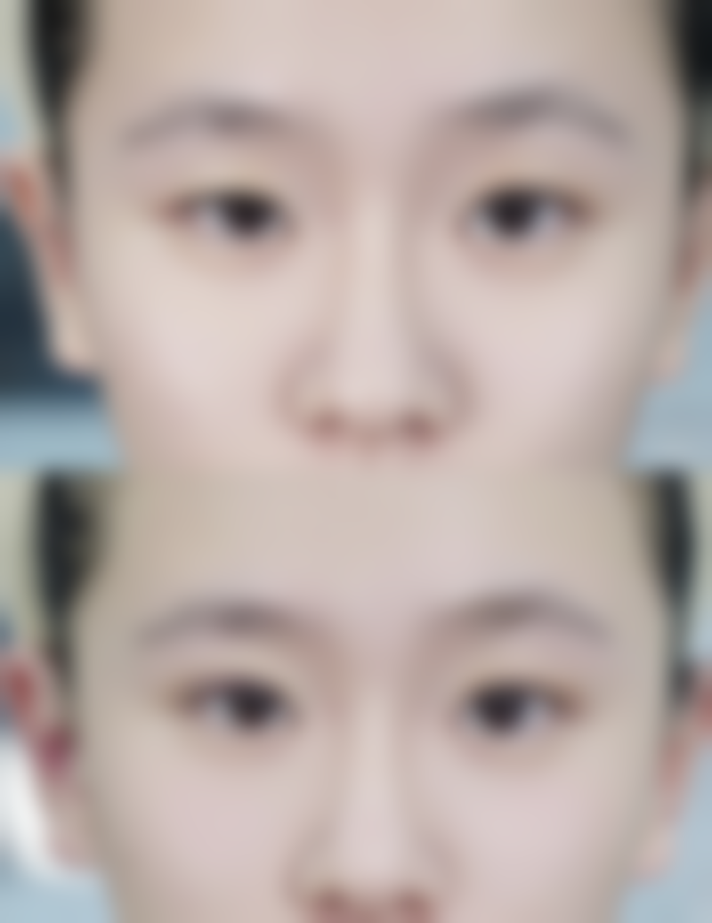 五、30年疤痕修复的注意事项