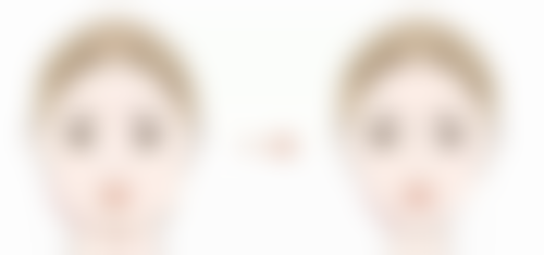 二、手术方式对拆纱布时间的影响