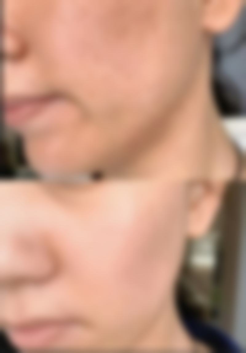 二、普通缝合与整形缝合对比