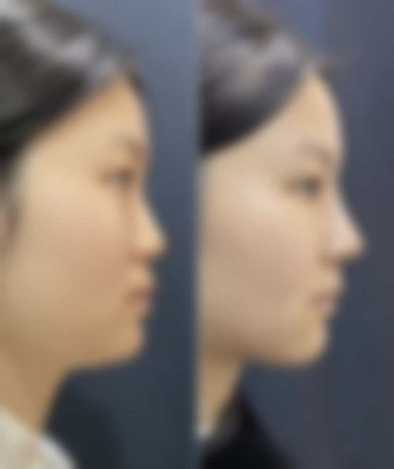 自体脂肪隆胸有哪些方法、效果及危害后遗症？一文为你全面揭秘 