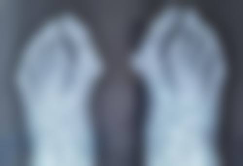 一、剖宫产疤痕的状态评估