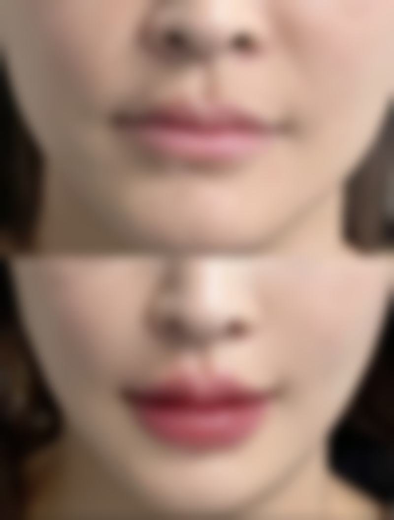 全身吸脂能维持多久？揭秘影响维持时间的因素及术后长久塑形秘诀 