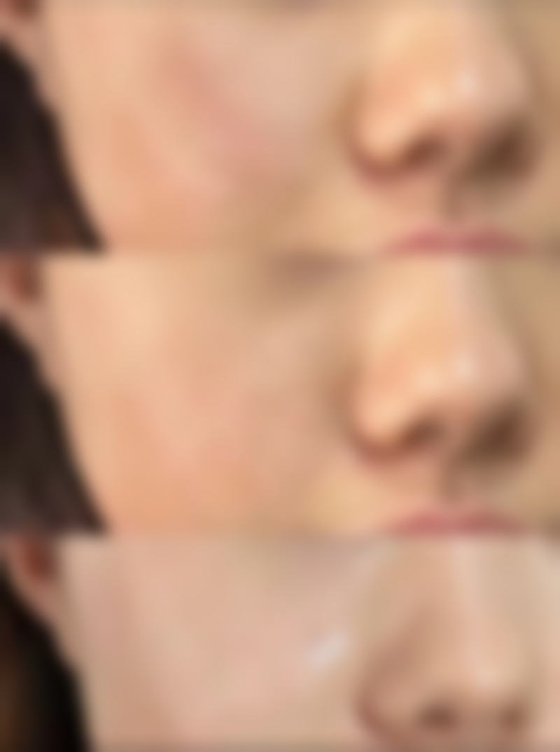 隆鼻膨体是终身的吗？揭秘膨体隆鼻维持时间及影响因素，让你心中有数！ 