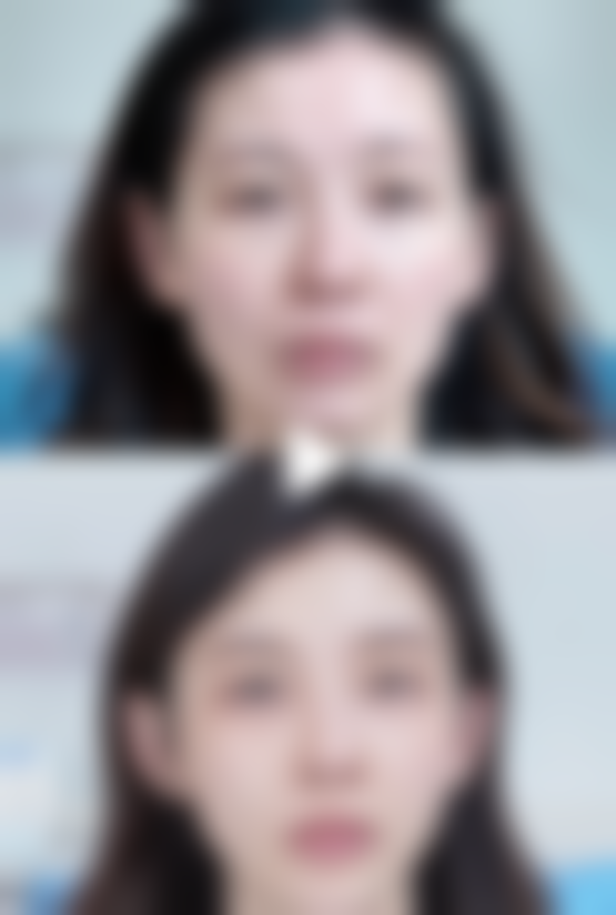 一、全身吸脂能维持多久：成效因人而异