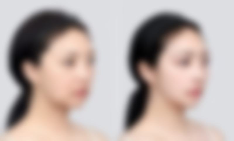 二、吃辣对全切双眼皮修复的影响