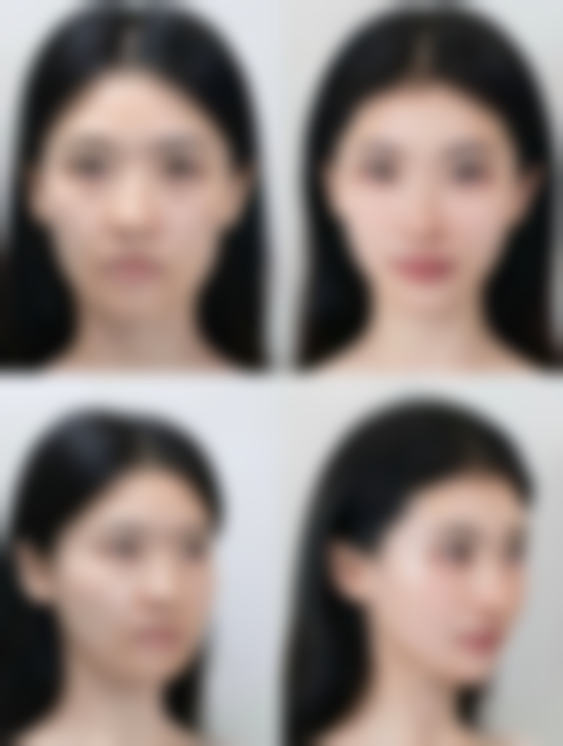 一、全切双眼皮术后修复情况