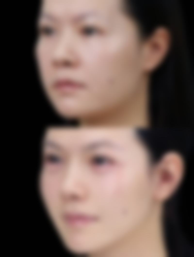 七、综合治疗疤痕疙瘩