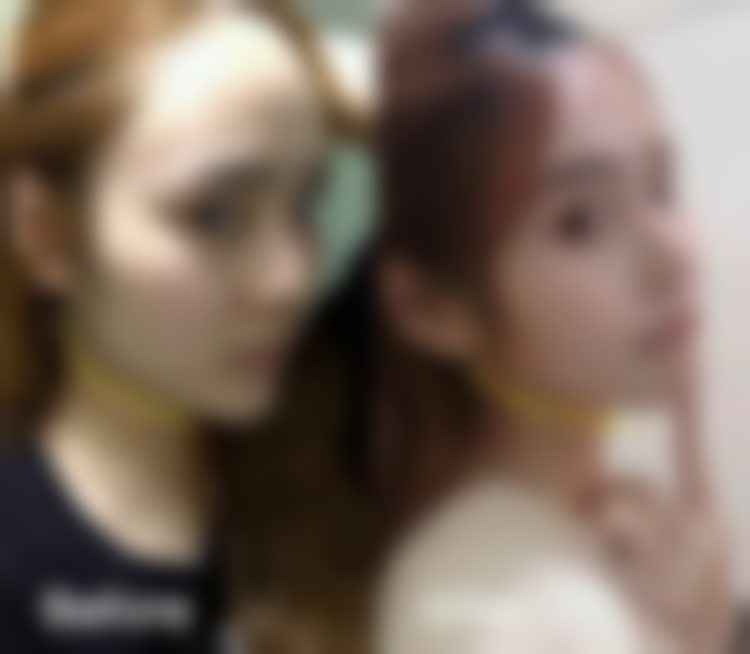 四、杭州连天美医疗美容医院乔雅登丰颜玻尿酸项目的真实实例