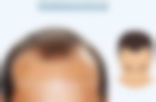 阴道紧缩术还能生孩子吗？手术方式、恢复情况及个体差异影响生育评估