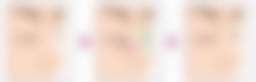 二、眼袋手术属于微创吗之常见手术方法