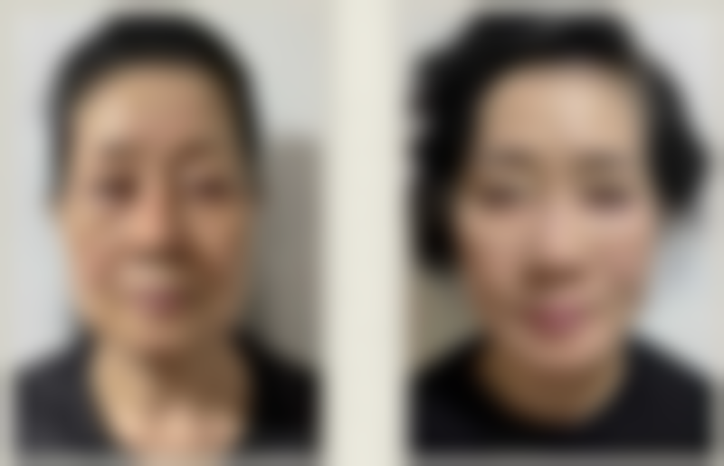 黑眼袋是怎么引起的吗？揭秘遗传、睡眠、衰老等多因素致黑眼袋成因 