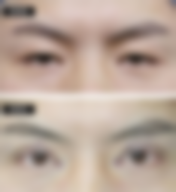 四、眼袋手术属于微创吗之手术前后注意事项