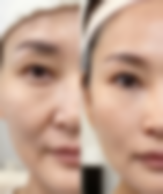 二、阴道紧缩术还能生孩子吗之修复情况的考量