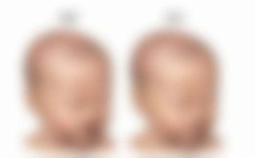 三、怎么能治疤痕增生之治疗方案