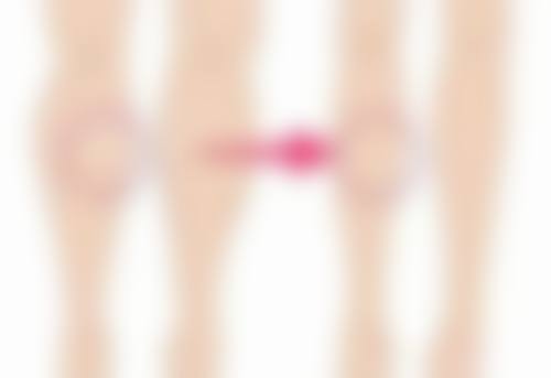 三、瘢痕体质者不适宜割双眼皮