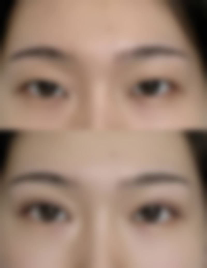 一、割眼袋和割双眼皮修复速度的总体情况