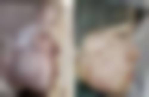 四、双眼皮宽度变化的正常过程