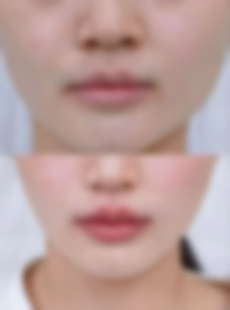 五、去除眼袋的其他方法