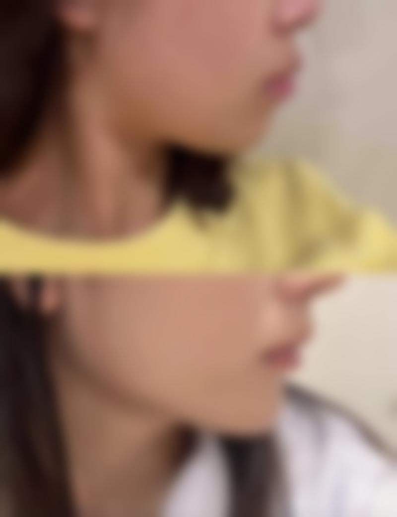 三、肋软骨隆鼻的成效