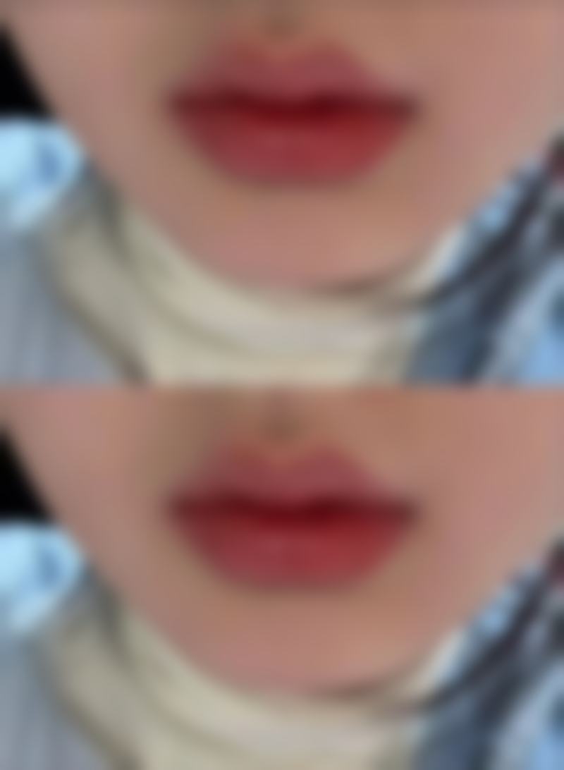 二、假体隆胸怎么做的：手术过程