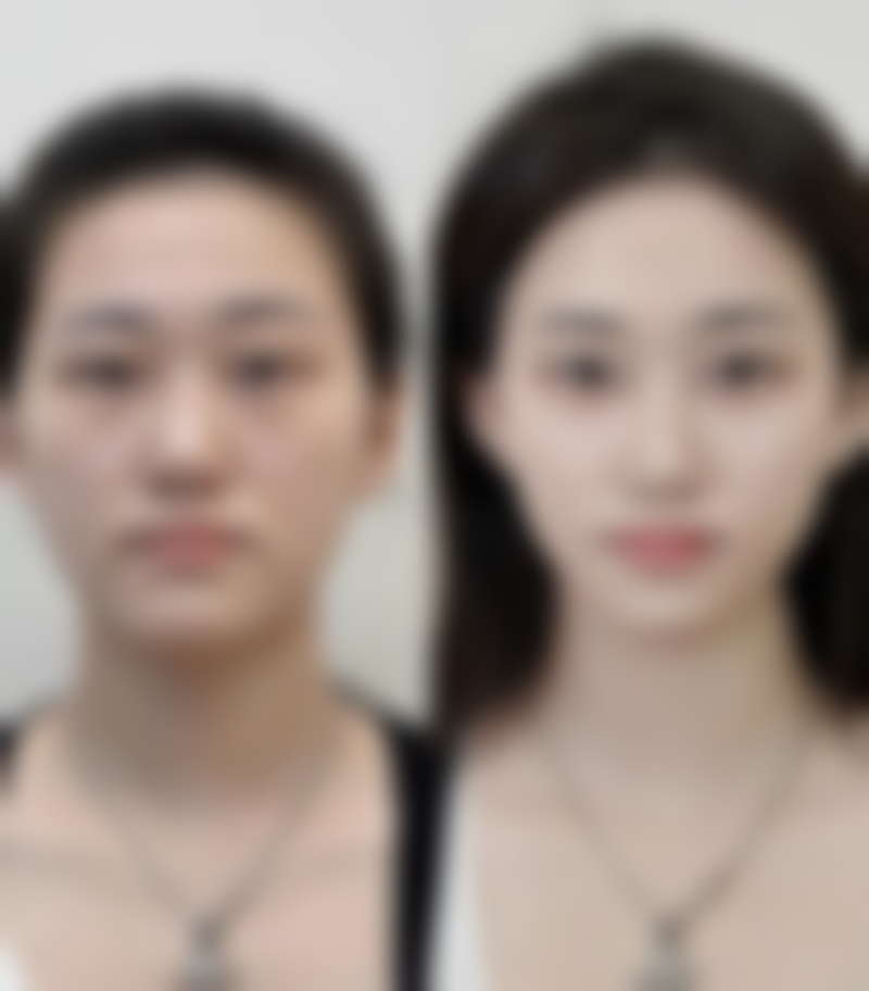 五、隆胸能给小孩喂奶吗？其他注意事项