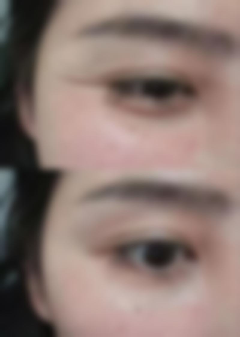 二、割了双眼皮不同阶段的护理重点及祛疤膏使用建议