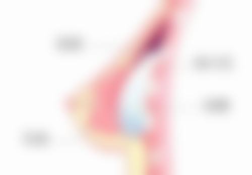 六、总结手臂抽脂塑身衣穿多久