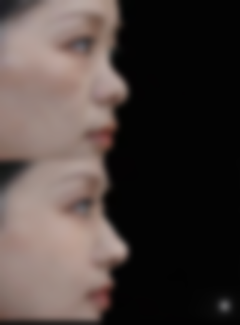 五、眼袋怎么消除手术之手术费用参考