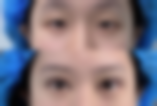 三、眼袋怎么消除手术之美学设计要点