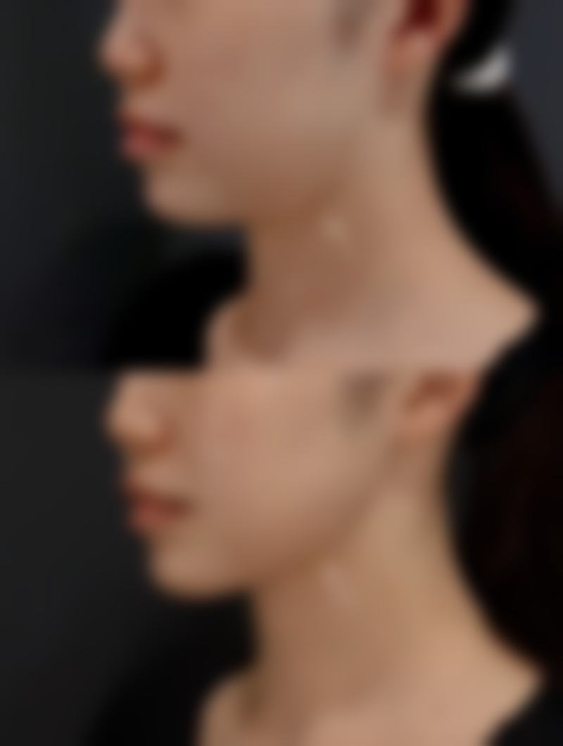 全切双眼皮宽能修复窄吗？答案揭晓，术后修复变窄方法与要点大揭秘 